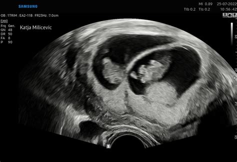 Ženska, ki se sprašuje med dvema možnostma, PMS in nosečnost