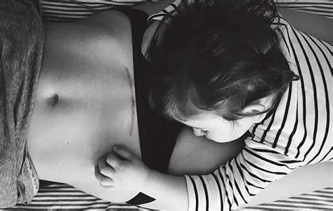 Brazgotina po carskem rezu