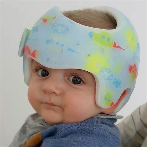 Ilustracija primerov plagiocefalije in brahiocefalije