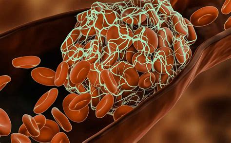 Ilustracija krvnega strdka v žili