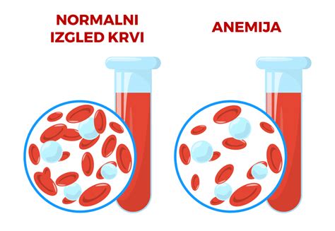 Prikaz ravni hemoglobina v nosečnosti