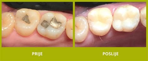 Diagram primerjave amalgamske in bele zalivke