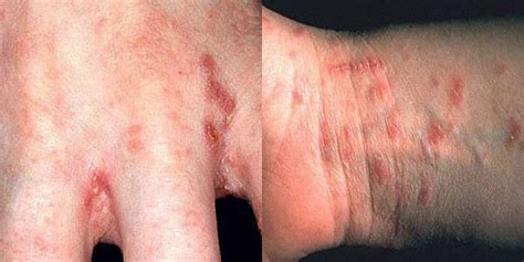 Simptomi toksoplazmoze pri ljudeh