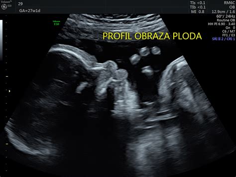 Diagram meritev ploda z ultrazvokom