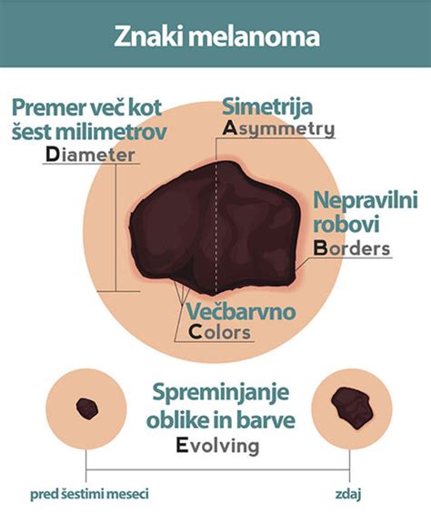 Dermoskopski pregled znamenj