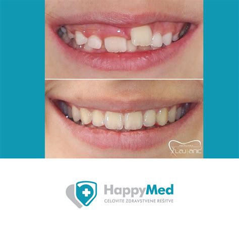 Primerjava strij pred in po zdravljenju