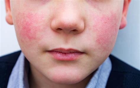 Izpuščaj na obrazu, značilen za peto bolezen