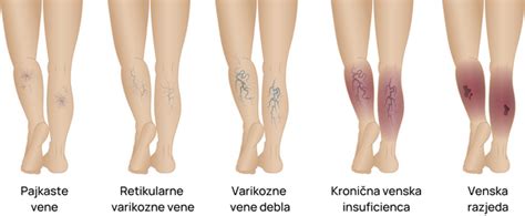 Diagram delovanja venskih zaklopk v nogi