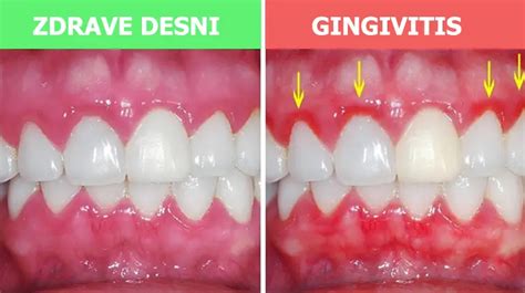 Ilustracija nosečniškega gingivitisa