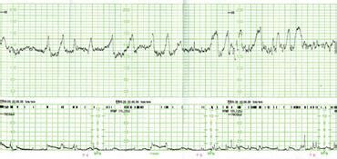 Diagram: Spremljanje srčnega utripa ploda s CTG