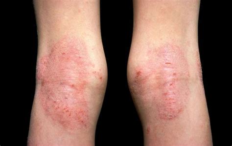 Ilustracija otroka z izpuščaji na obrazu